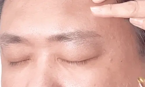 남성_눈썹제모