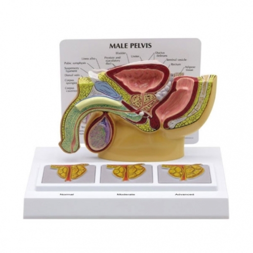  GPI 전립선질환 모형 (G3551)