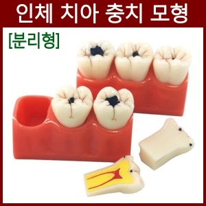 인체 치아 충치 모형R 진행관찰 수업이미지입니다. 누르면 해당 게시물로 새창이동합니다.