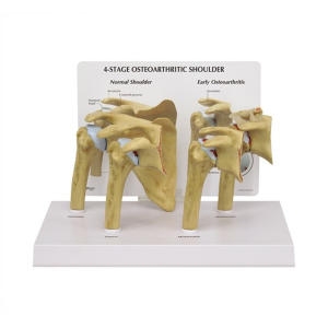 GPI G180 퇴행성 어깨관절모형이미지입니다. 누르면 해당 게시물로 새창이동합니다.