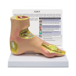  GPI G1985 발 통풍 모형