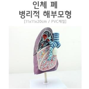 인체 폐 병리적 해부모형R