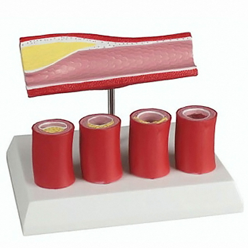 ErlerZimmer 동맥내 플라크로 혈관이 좁아지는것을 보여주는 모형 (G240)이미지입니다. 누르면 해당 게시물로 새창이동합니다.